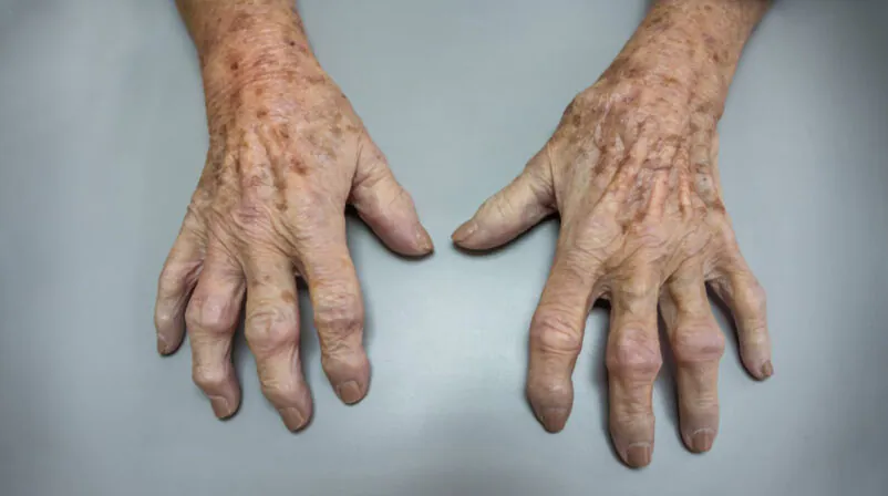 Artrose: sintomas, causas e tratamento