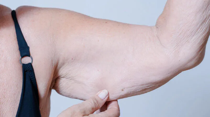 Sarcopenia em idosos: Fraqueza Muscular