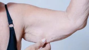 fraquesa-muscular-sarcopenia Sarcopenia em idosos: Fraqueza Muscular